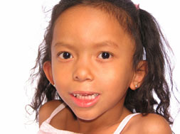 Cleft Lip Treatment & Cleft Palate Treatment | Orange County | Long Beach