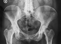 Hip Dysplasia Treatment | Perthes Disease Treatment | Clubfoot Treatment | Orange County | Long Beach
